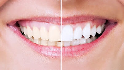 Răng Sứ Zirconia Và 5 Lưu Ý Khi Bọc Răng Sứ 2