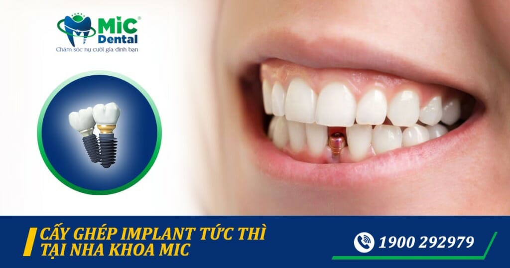Trồng răng Implant giá bao nhiêu? Bảng giá Implant 2024 nha khoa MIC 5