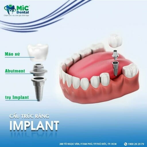 Trồng răng Implant giá bao nhiêu? Bảng giá Implant 2024 nha khoa MIC 2