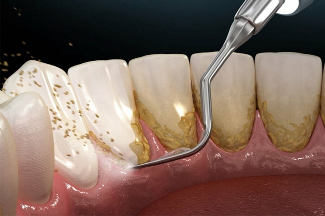 Viêm Nướu Răng Và 5 Cách Phòng Bệnh Hiệu Quả 1