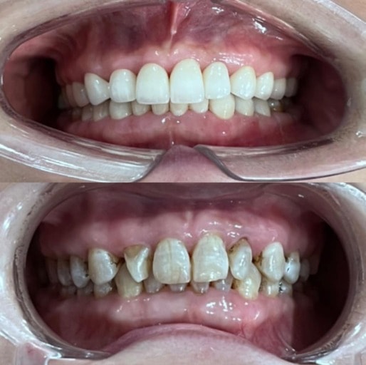 Răng Sứ Zirconia Và 5 Lưu Ý Khi Bọc Răng Sứ 5