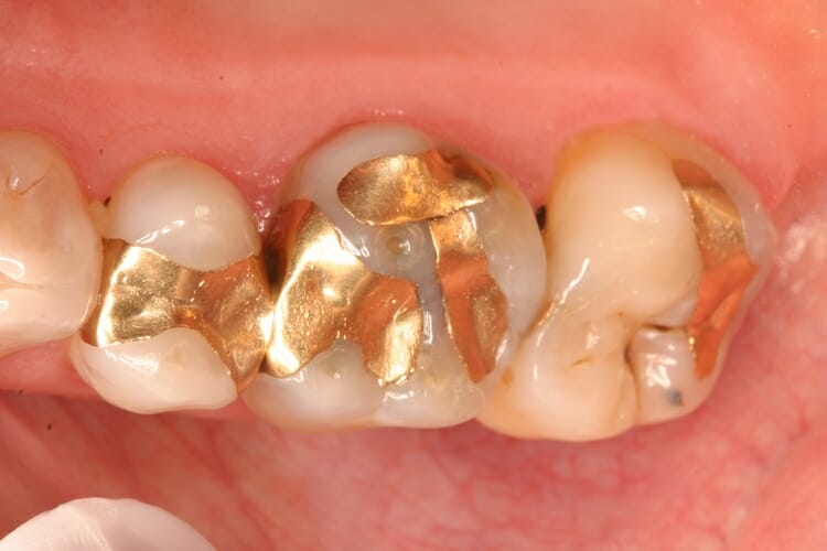 trám răng bằng vàng