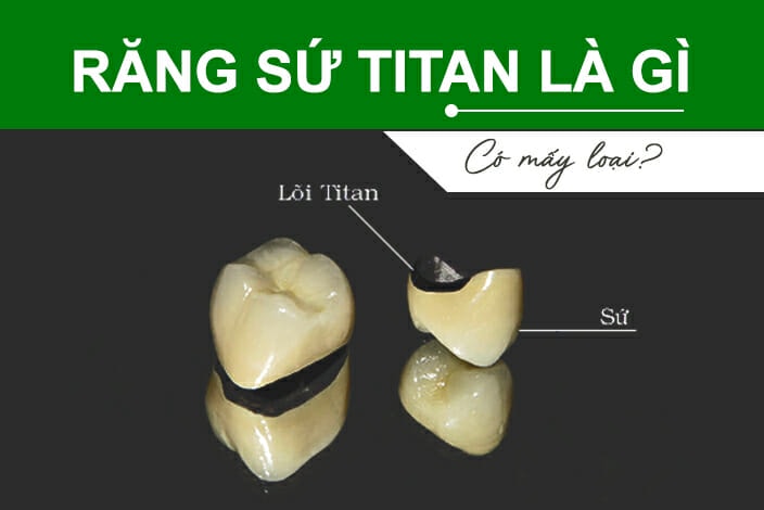 răng sứ titan