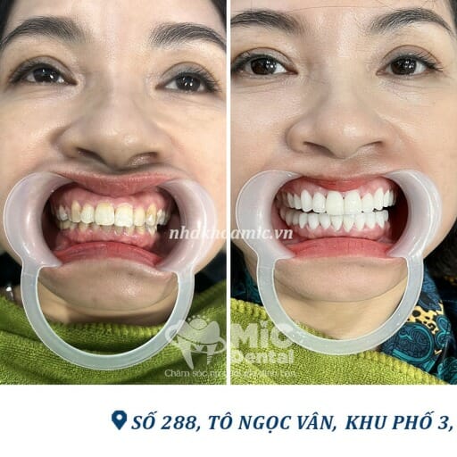 bọc răng sứ 2 răng cửa