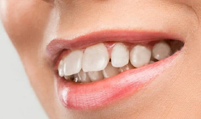 Cách làm răng hết hô tại nhà có thật sự hiệu quả? 5