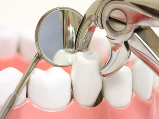 Niềng răng phải nhổ răng nào? Khi nào nên nhổ? 2