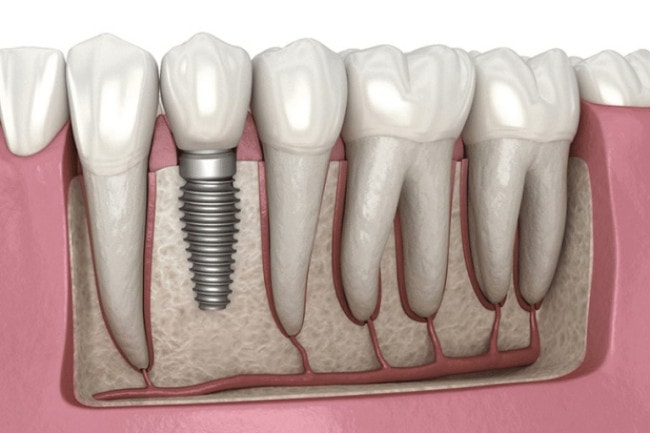 Mất răng riêng lẻ nên trồng Implant để phục hình răng