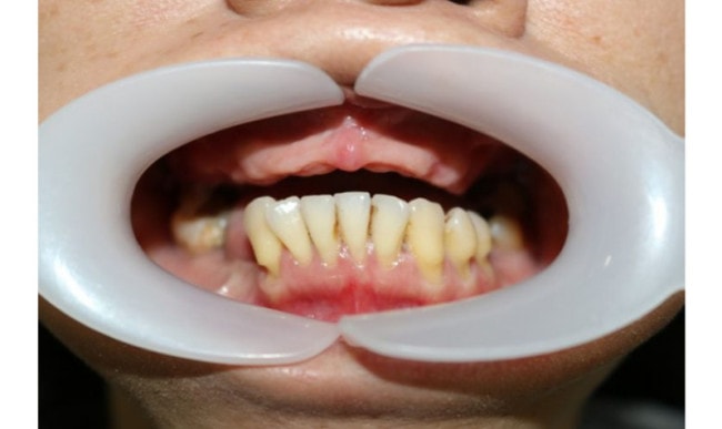 Khi nào nên trồng răng Implant? Bệnh nhân nên trồng khi mất răng toàn hàm