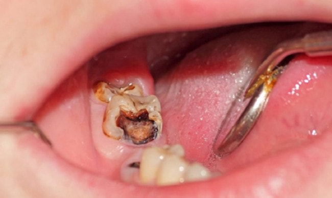Sâu răng ăn vào tủy là trường hợp nên trồng răng Implant