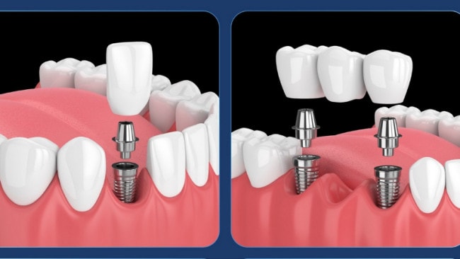 Trồng răng Implant có độ bền cao, đảm bảo tính chân thực khi sử dụng