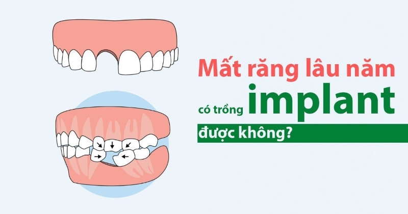 Mất Răng Lâu Năm Có Trồng Implant Được Không? 8