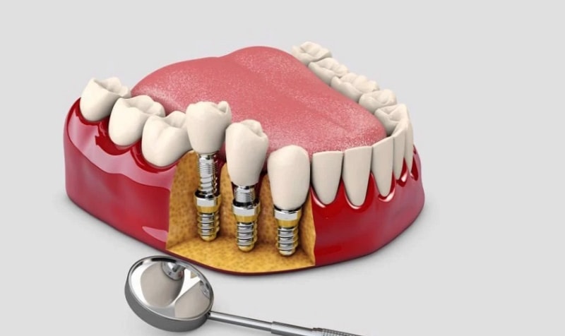 Mất răng lâu năm có trồng Implant được không? Câu trả lời là ĐƯỢC
