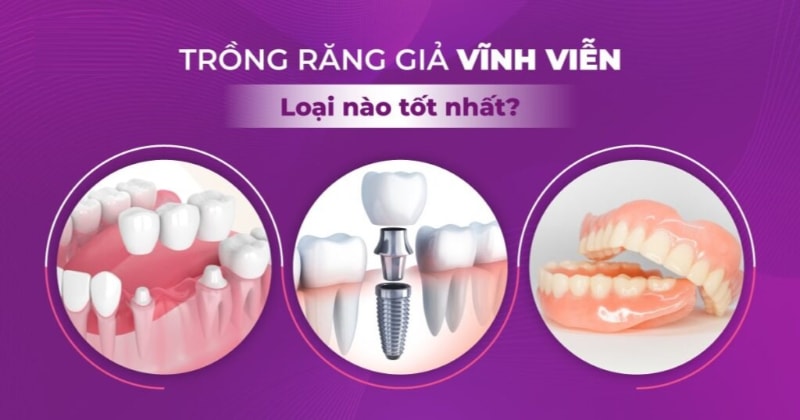 Nên trồng răng loại nào? Top 6 phương pháp phục hình răng tốt nhất hiện nay 17