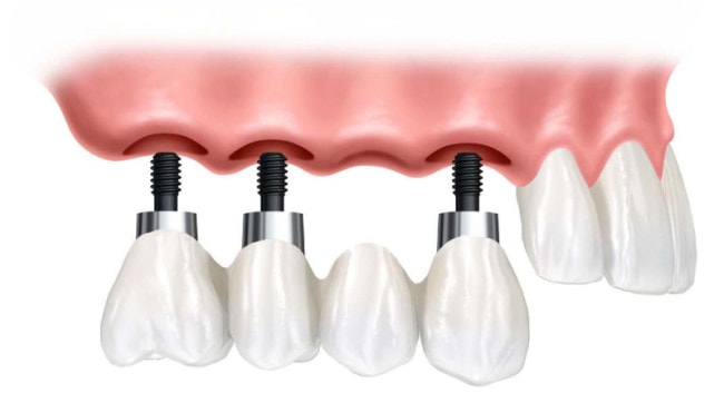 Cầu răng trên Implant