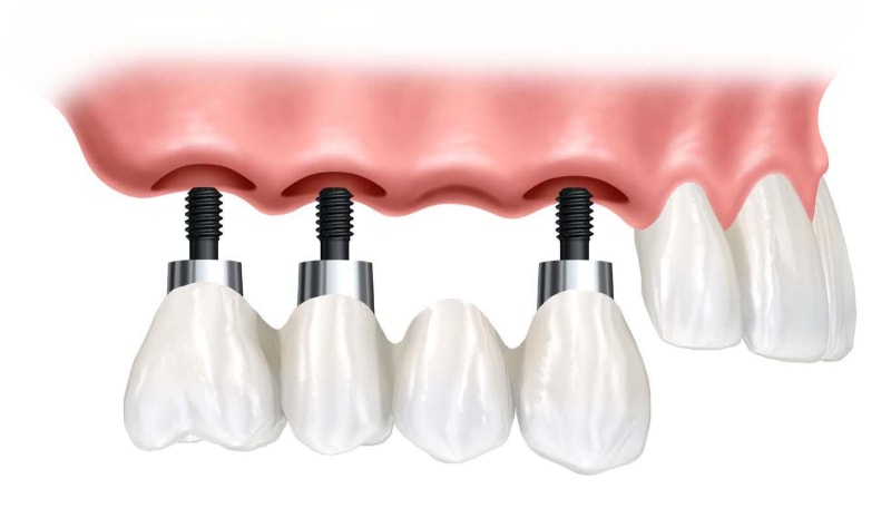 Cầu răng trên Implant