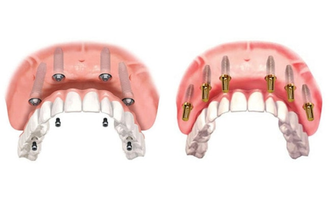 Trồng răng toàn hàm Implant All-on-4