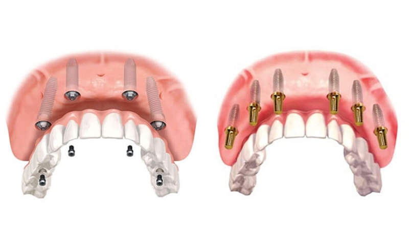 Trồng răng toàn hàm Implant All-on-4