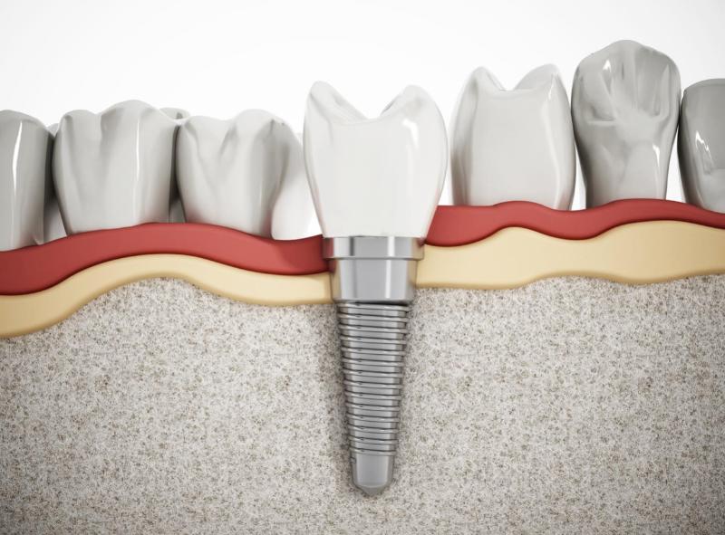 Răng Implant bị lung lay có thể do không tích hợp với xương hàm