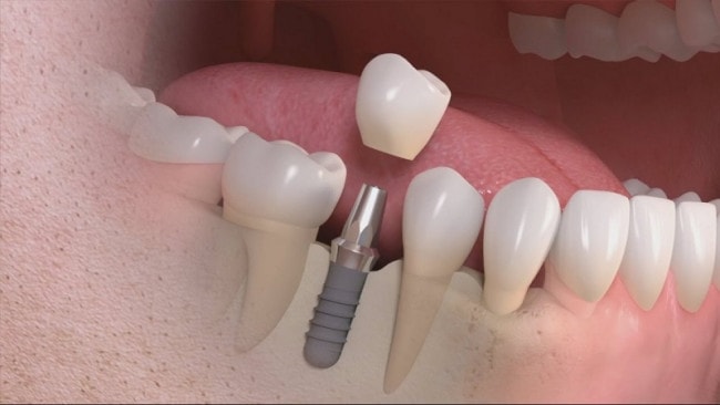 Cấy ghép Implant không mài mòn đến các chiếc răng, giữ nguyên răng thật