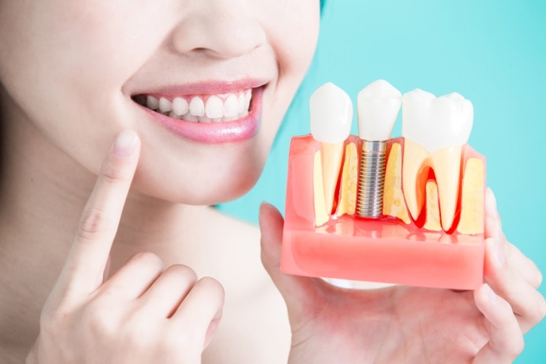 Răng Implant có độ bền lâu dài lên đến 10-20 năm