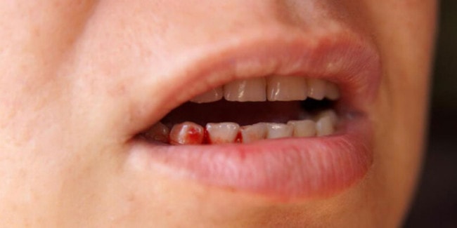 Trồng răng Implant có thể gây chảy máu liên tục