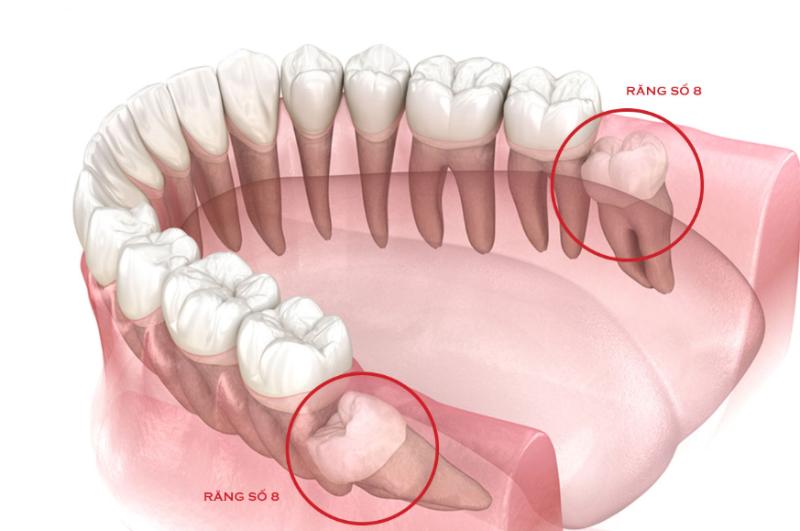 Trồng răng hàm sâu bao nhiêu tiền? Có những phương pháp nào hiệu quả? 5
