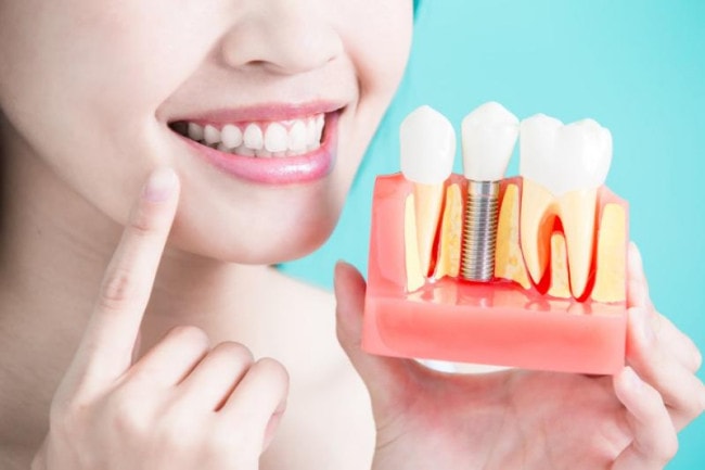 Răng hàm bị sâu được trồng lại mang đến nhiều lợi ích