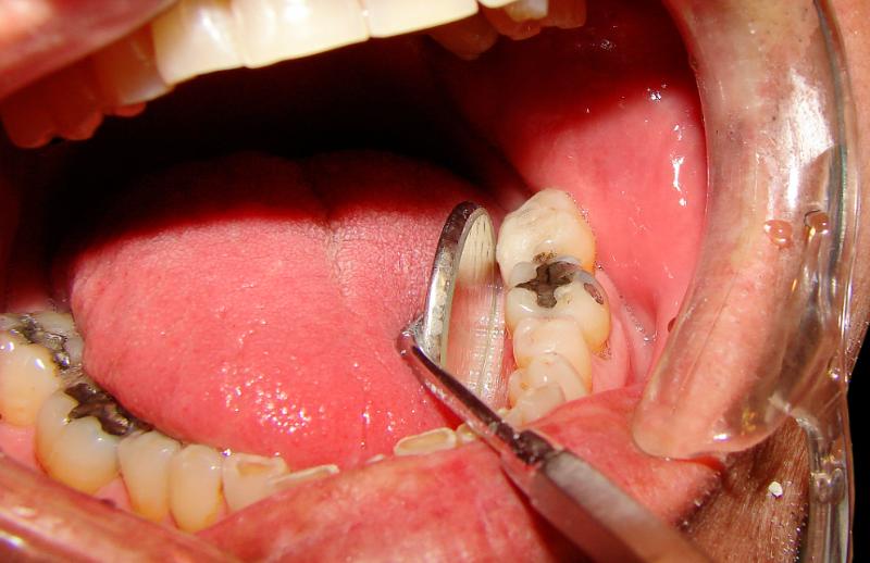 Mỗi tình trạng răng hàm sâu khác nhau sẽ có phương pháp trồng khác nhau
