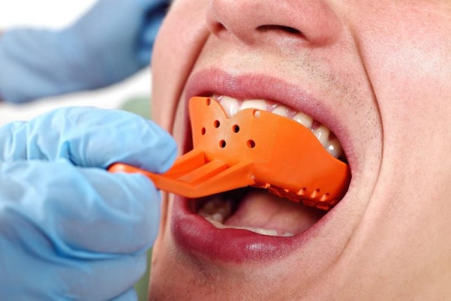 Phương pháp tháo lắp hàm giả cho rằng hàm sâu có thể bảo tồn được răng thật