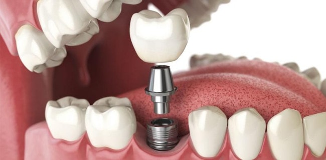 Trồng răng hàm sâu bằng phương pháp Implant cho cảm giác thật và bền