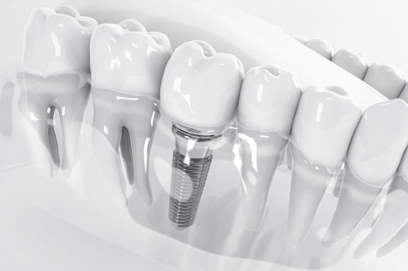 Trồng Răng Implant Giá Rẻ: Những Nguy Hiểm Tiềm Ẩn 1