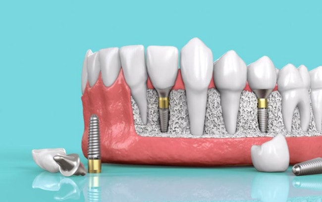 Phương pháp trồng răng Implant giá cao bởi vật liệu hiếm