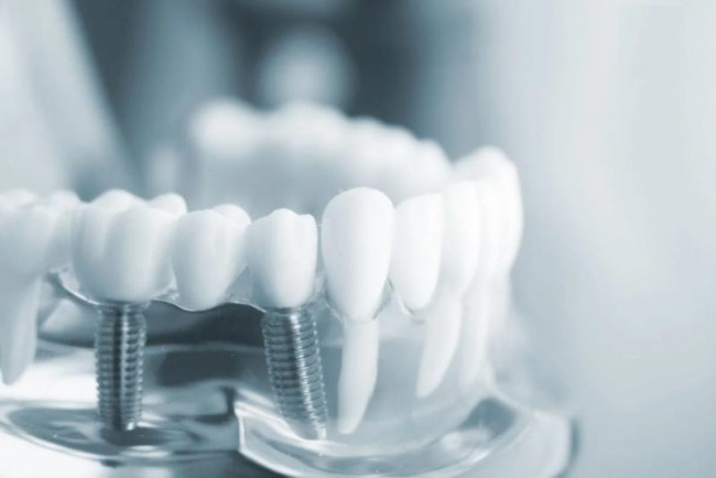 Trồng răng phương pháp Implant giá rẻ tại nơi không uy tín dễ tiền ẩn nguy hiểm