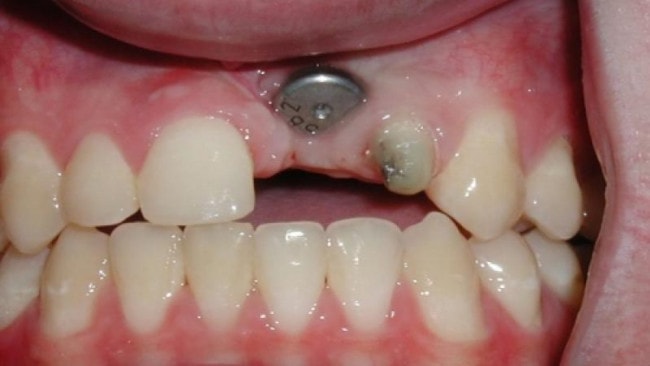 Trồng răng Implant giá thấp nhưng nha khoa kém uy tín dễ làm tổn thương răng
