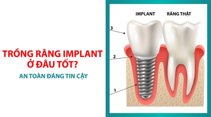 Trồng Răng Implant Ở Đâu Tốt Nhất? Các Tiêu Chí Đánh Giá 9