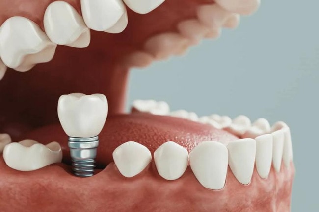Phương pháp Implant trồng răng số 6 đảm bảo an toàn, hiệu quả