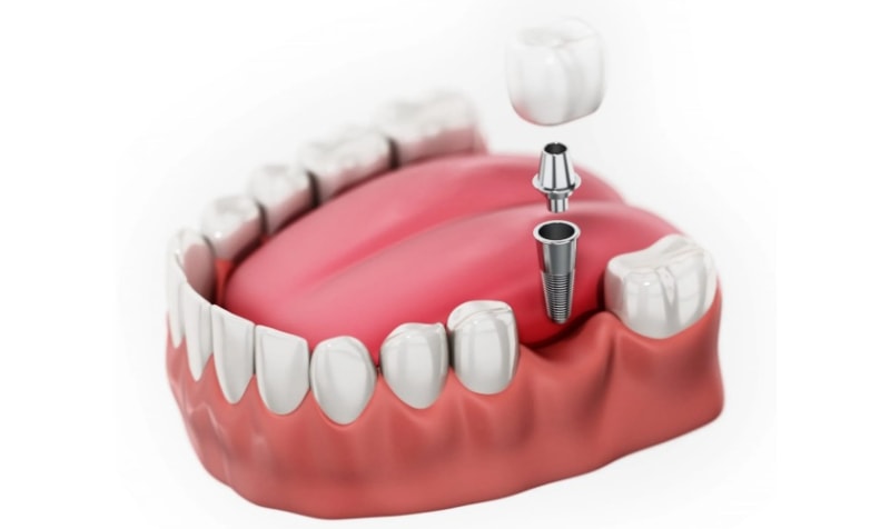 Mất 1 chiếc răng hàm thì trồng răng Implant là tốt nhất