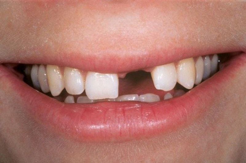 Mất 2 răng liền kề: Nguyên nhân, giải pháp xử lý hiệu quả bền đẹp