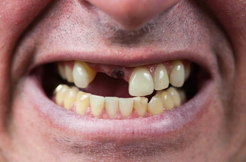 Bị mất 2 răng liền kề gây ảnh hưởng đến khả năng ăn nhai và gây mất thẩm mỹ