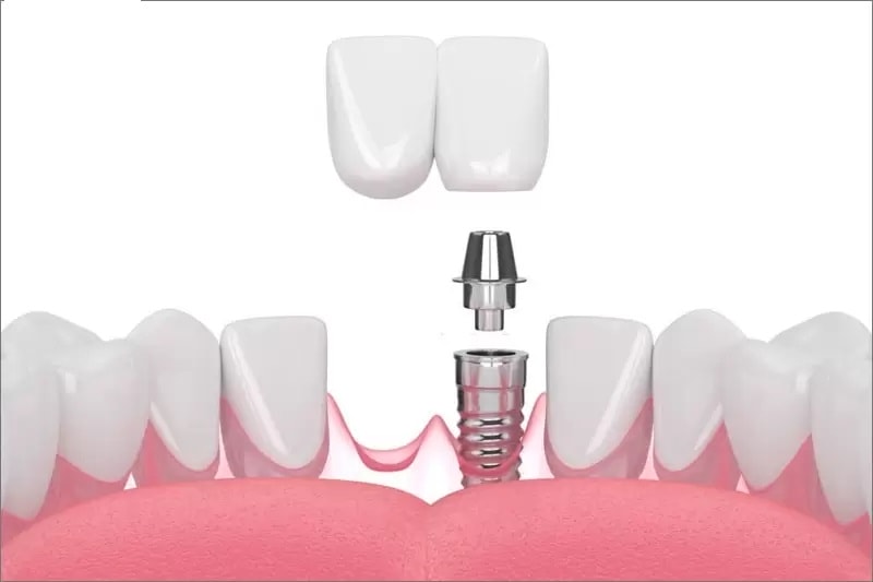 Cấy trụ Implant giúp khắc phục nhanh chóng bị mất 2 răng liền kề