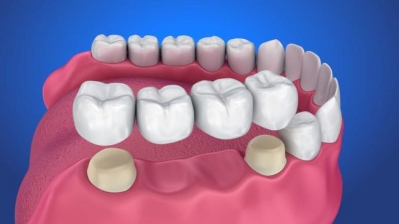 Lắp cầu răng sứ cần phải có trụ răng bên thật chắc khỏe