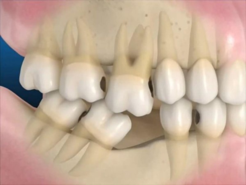 Hậu quả của việc mất răng đó là ảnh hưởng sức khỏe răng miệng