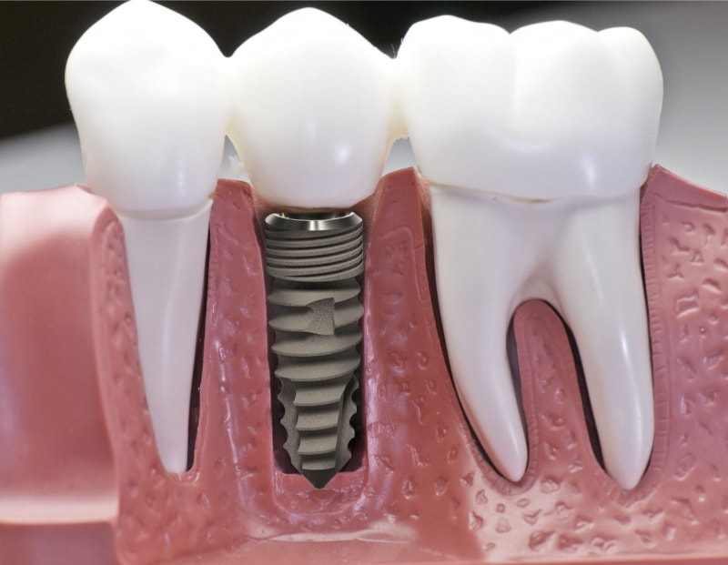 Trồng răng Implant là cách khắc phục mất răng gây lệch mặt tốt nhất