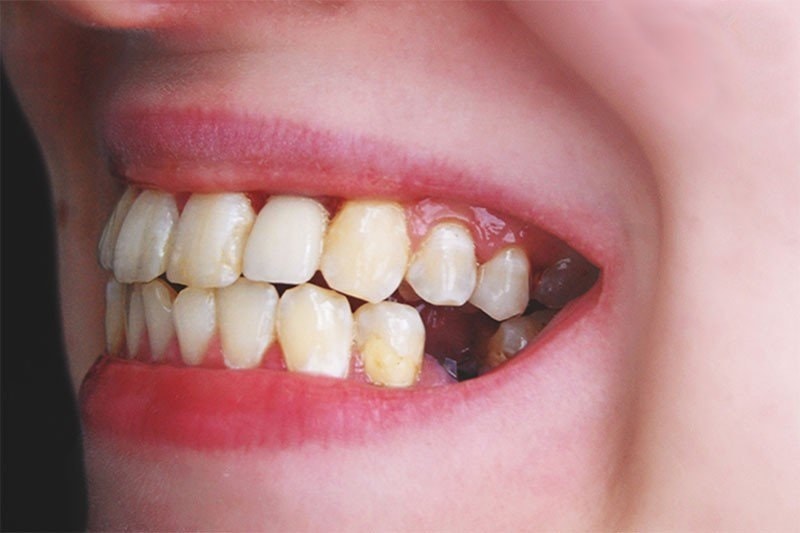 Mất răng gây mất thẩm mỹ, khiến hàm răng có khoảng trống lớn
