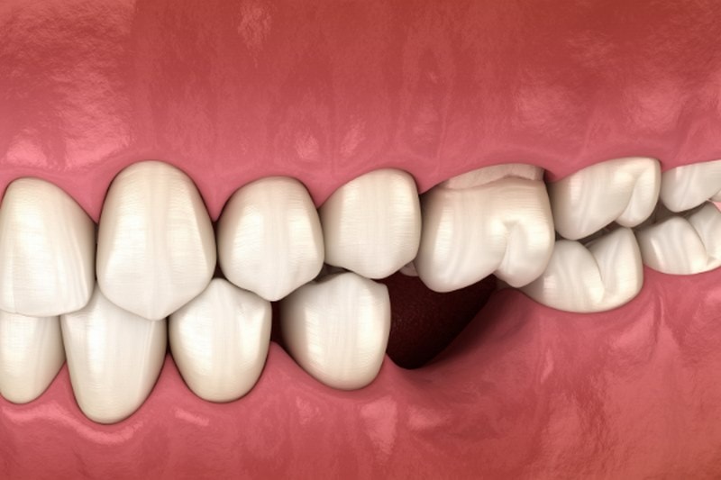 Bị mất răng hoàn toàn có thể niềng được một cách dễ dàng