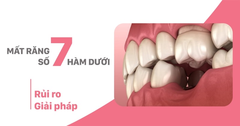 Mất răng số 7 hàm dưới: Hậu quả và cách khắc phục hiệu quả 3