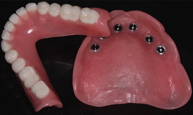 Hàm giả tháo lắp là cách phục hình răng 7 hàm dưới hợp với người lớn tuổi