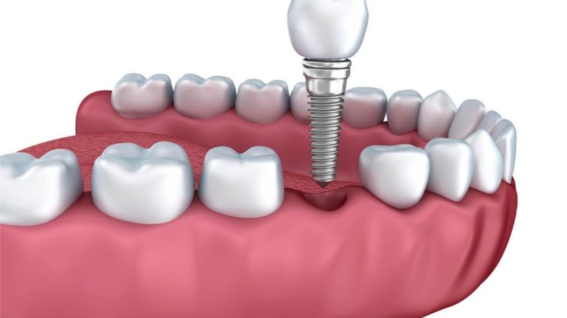 Trồng răng Implant là cách phục hình răng số 7 hàm dưới tối ưu nhất