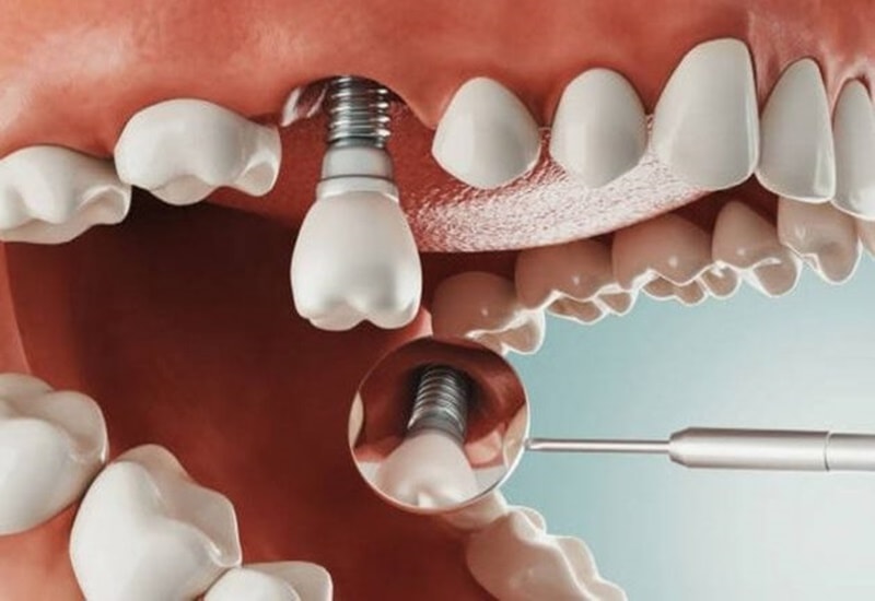 Cách phục hình tốt nhất khi mất răng số 7 hàm trên là trồng răng Implant