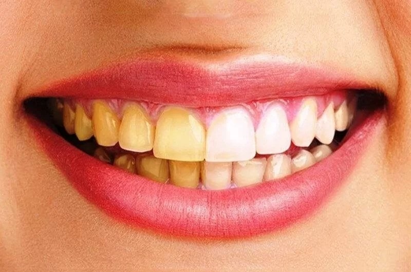 Răng ngả vàng là do men răng yếu
